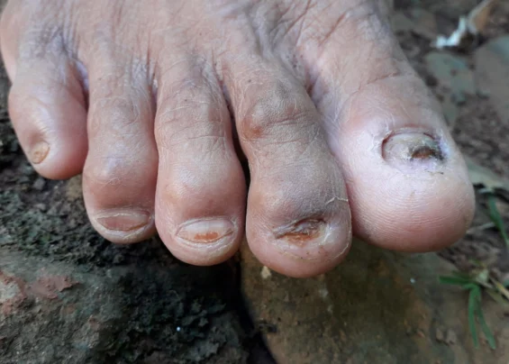 Onychomycosis scaled 1 qoajnt7ezf6gfh1dsm9a15u9n0dklddgvslhcrvbig Trillium Clinic Dermatology Chapel Hill