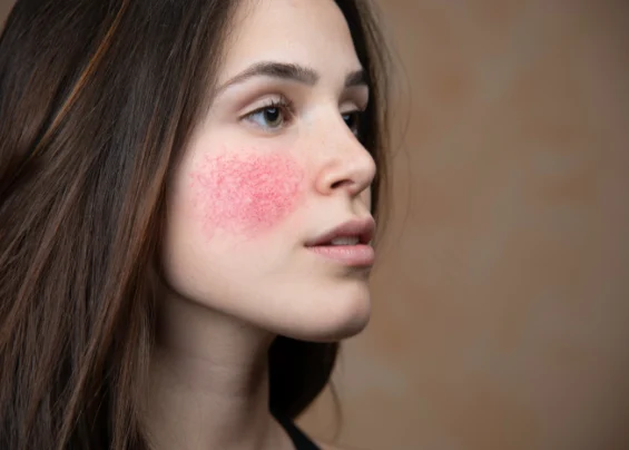 Rosacea Trillium Clinic Dermatology Chapel Hill