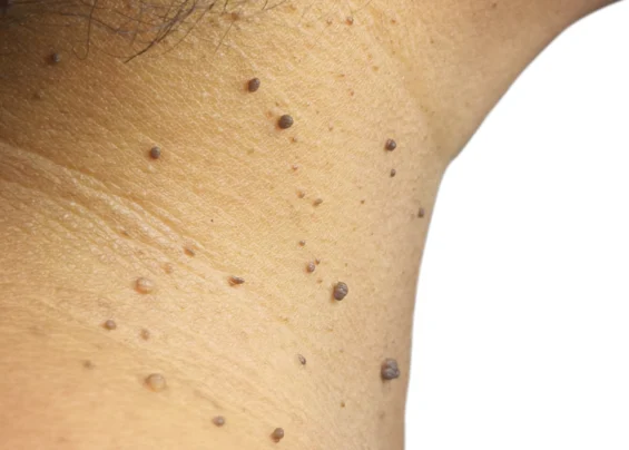 Skin Tags scaled 1 Trillium Clinic Dermatology Chapel Hill