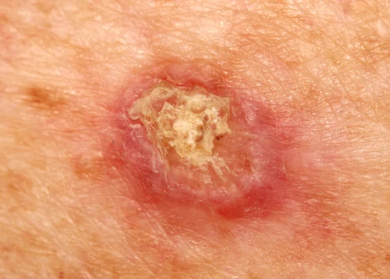 Squamous Cell Carcinoma