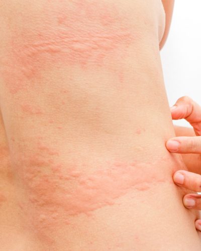 Women,With,Symptoms,Of,Itchy,Urticaria.