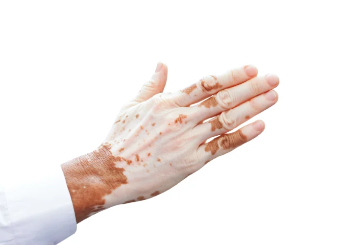 Vitiligo-scaled