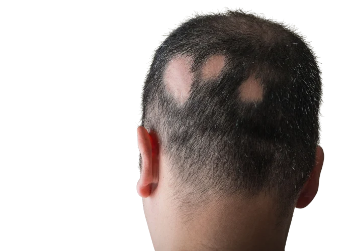 alopecia areata