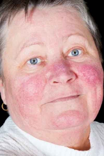 discoidlupus