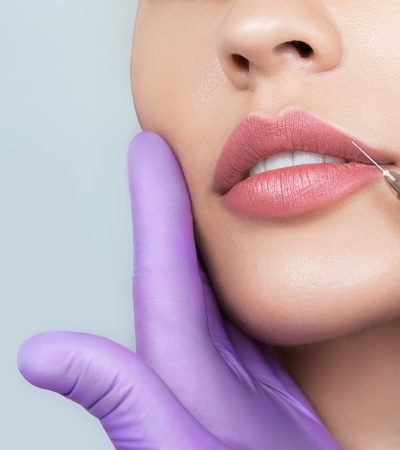 Cropped,Sensual,Female,Lips,,Procedure,Lip,Augmentation.,Syringe,Near,Womans