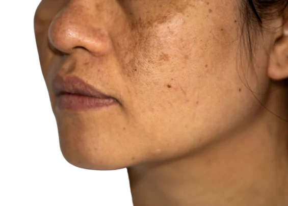 melasma qoajnt7ezf6gfh1dsm9a15u9n0dklddgvslhcrvbig Trillium Clinic Dermatology Chapel Hill