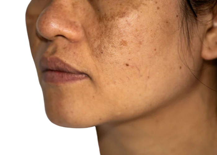 melasma