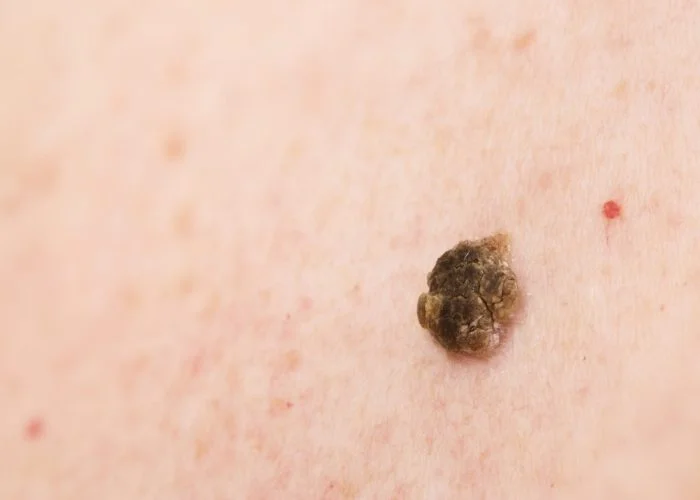 Seborrheic keratosis also known as seborrheic verruca or a senile wart, narrow focus