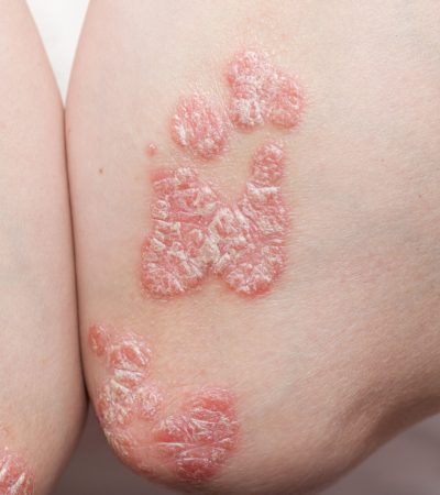 Problem,Skin,Psoriasis,On,The,Body.,Exacerbation,Of,Psoriasis.,Stress